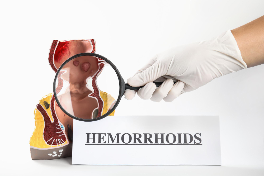 Hemorrhoids