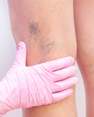Vascular Surgery
